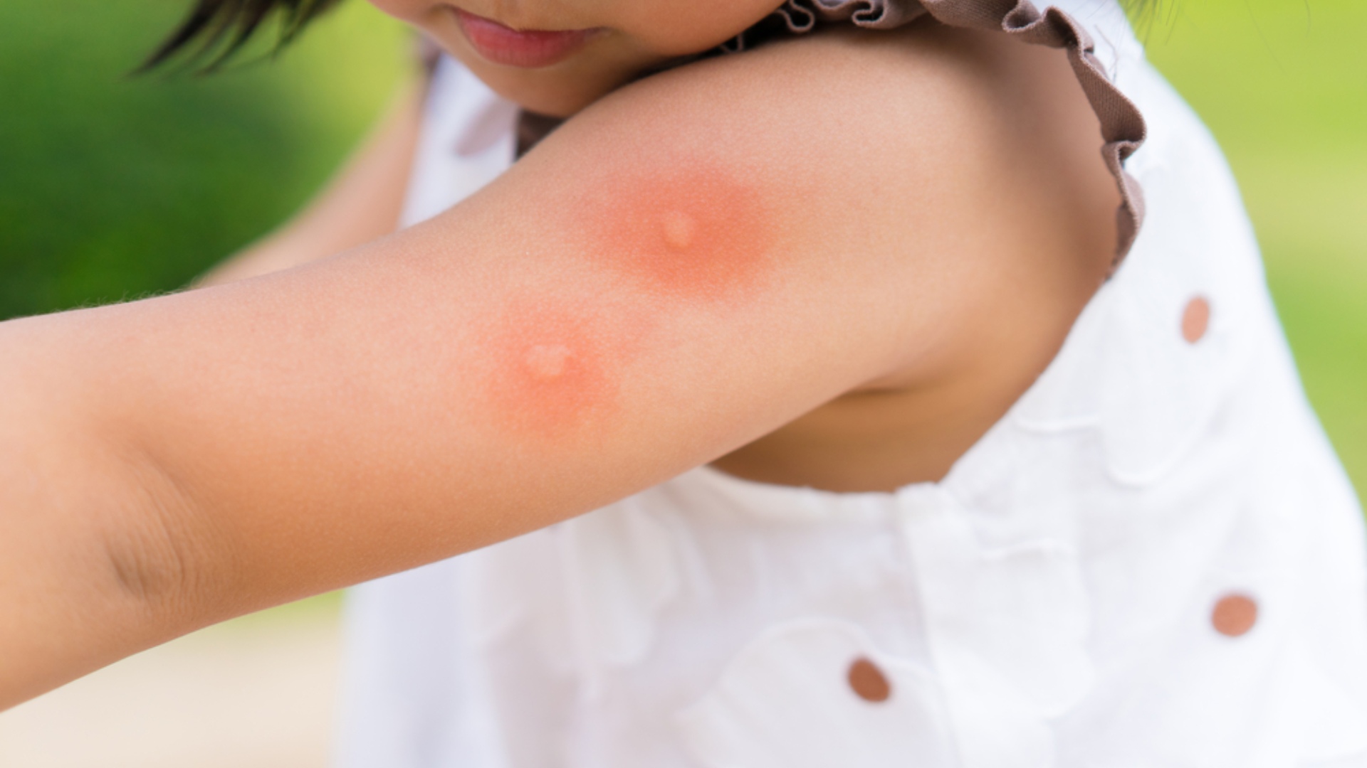 Stop the Itch! Deter Mosquitoes From Hanging Around on Your Property